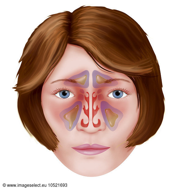 Illustration Of The Various Paranasal Sinuses That Are Infected During ...