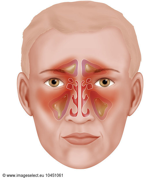 illustration-of-the-various-paranasal-sinuses-that-are-infected-during