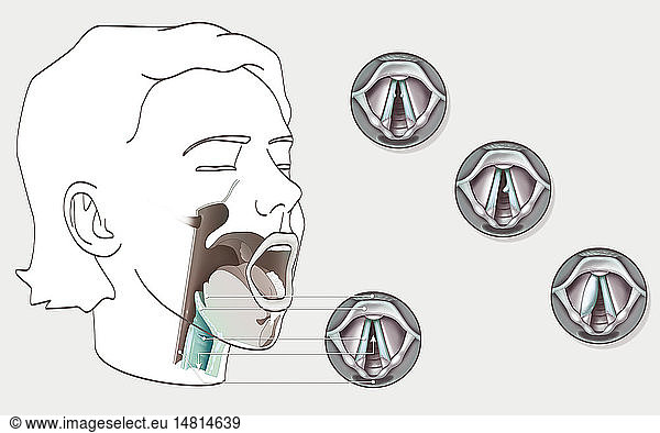 Illustration of vocal cord pathologies. On the left Illustration of ...