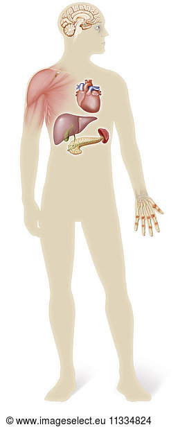Illustration von Organen  die von Hämochromatose betroffen sind  einer vererbbaren genetischen Störung  die das HFE-Gen auf Chromosom 6 betrifft. Diese Störung verursacht ein Ungleichgewicht des eisenhaltigen Transferrins im Blut. Dieses Ungleichgewicht führt zu einer übermäßigen Eisenaufnahme und zu einer Überlastung der Eisenspeicher bestimmter Organe: Gehirn  Muskeln  Herz  Leber  Milz  Bauchspeicheldrüse  Haut und Knochen.
