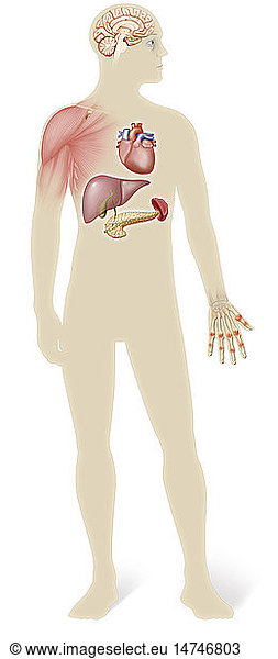 Illustration von Organen  die von Hämochromatose betroffen sind  einer vererbbaren genetischen Störung  die das HFE-Gen auf Chromosom 6 betrifft. Diese Störung verursacht ein Ungleichgewicht des eisenhaltigen Transferrins im Blut. Dieses Ungleichgewicht führt zu einer übermäßigen Eisenaufnahme und einer Überlastung der Eisenspeicher bestimmter Organe: Gehirn  Muskeln  Herz  Leber  Milz  Bauchspeicheldrüse  Haut und Knochen.