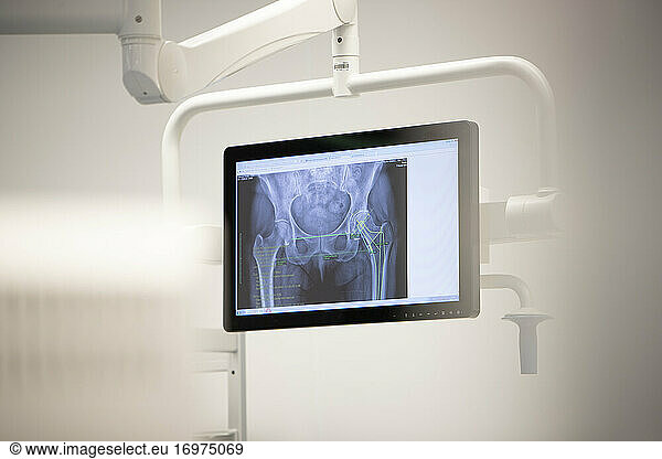 image of a hip x-ray on a screen in an operating theater