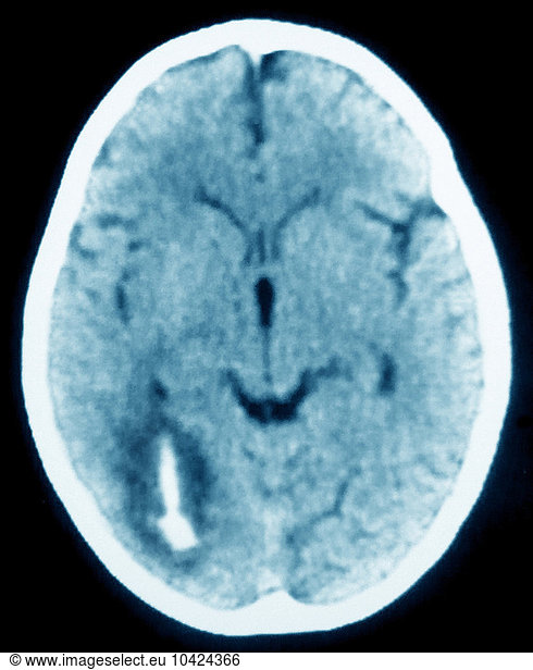 Intracerebral Hemorrhage (ICH) Intracerebral Hemorrhage (ICH), A Type ...