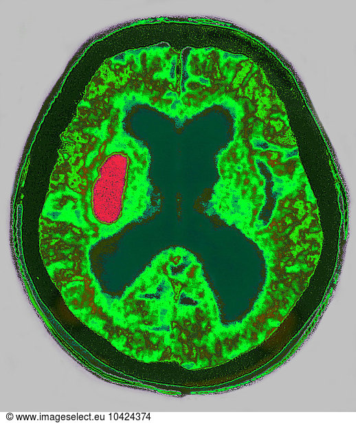 Intracerebral Hemorrhage (ICH) Intracerebral Hemorrhage (ICH), A Type ...