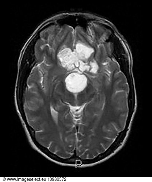 Intracranial Dermoid Cyst on MRI Intracranial Dermoid Cyst on MRI ...