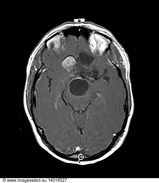 Intracranial Dermoid Cyst on MRI Intracranial Dermoid Cyst on MRI ...