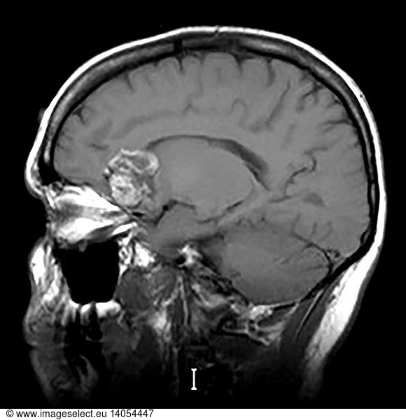 Intracranial Dermoid Cyst On Mri Intracranial Dermoid Cyst On Mri Abnormal Mri Brain Congenital