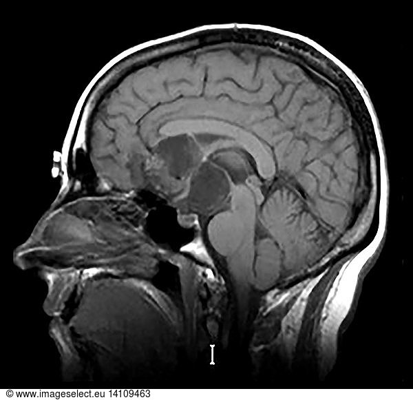 Intracranial Dermoid Cyst On Mri Intracranial Dermoid Cyst On Mri