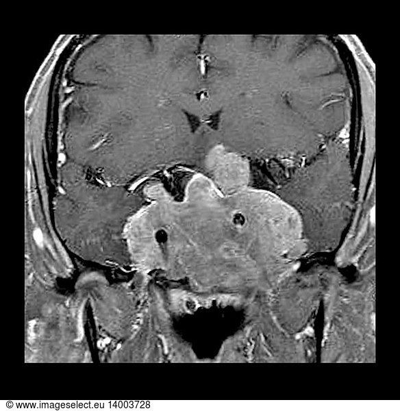 Invasive Pituitary Adenoma on MRI Invasive Pituitary Adenoma on MRI ...