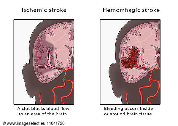 Ischemic Hemorrhagic Stroke Ischemic Hemorrhagic Stroke