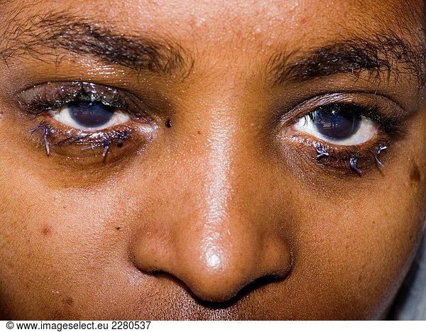 Junge mit Augenpunkte Krankheit. Addis Abeba