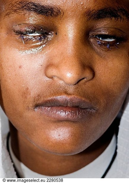 Junge mit Augenpunkte Krankheit. Addis Abeba  Äthiopien