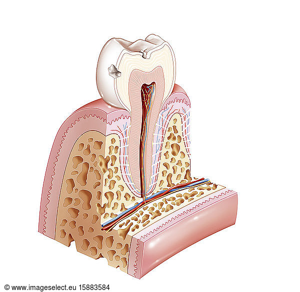 Karies im ersten Stadium  die den Zahnschmelz erreicht. Der Zahnschmelz ist die oberflächlichste Schicht der Zahnkrone. In dieser Zeichnung sind zwei Kariesstellen an einem unteren Prämolar zu sehen. Die eine befindet sich am Rand der Zahnkrone  die andere auf der Oberseite des Zahns in Höhe der Rillen. Zu diesem Zeitpunkt besteht kein Schmerzempfinden.