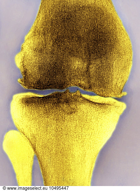 Knee Osteoarthritis Knee Osteoarthritis, X-ray,examination Medical 