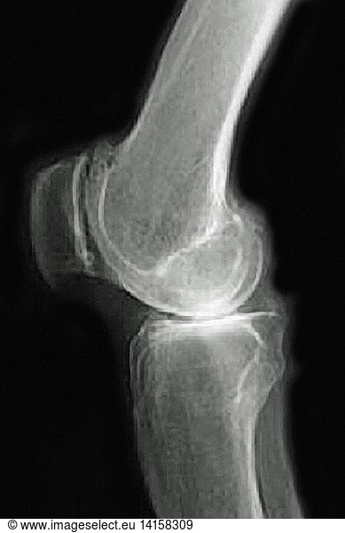 Knee Osteoarthritis Knee Osteoarthritis, X-ray,abnormal,abnormality ...