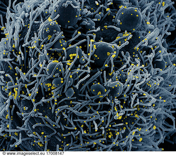 Koloriertes Rasterelektronenmikroskopbild einer apoptotischen Zelle (blau)  die mit SARS-COV-2-Viruspartikeln (gelb) infiziert ist und aus einer Patientenprobe isoliert wurde. Das Bild wurde in der NIAID Integrated Research Facility (IRF) in Fort Detrick  Maryland  aufgenommen. Bildnachweis: NIAID.