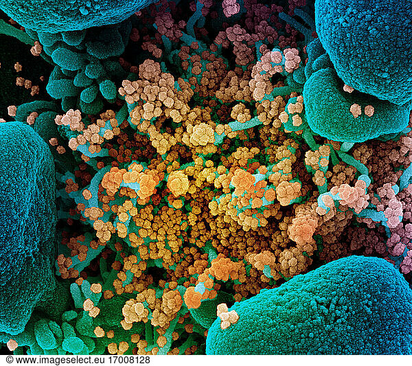 Koloriertes Rasterelektronenmikroskopbild einer apoptotischen Zelle (blau)  die stark mit SARS-CoV-2-Viruspartikeln (gelb) infiziert ist und aus einer Patientenprobe isoliert wurde. Das Bild wurde in der NIAID Integrated Research Facility (IRF) in Fort Detrick  Maryland  aufgenommen. Bildnachweis: NIAID.