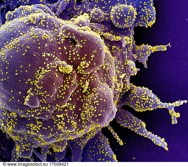 Koloriertes Rasterelektronenmikroskopbild einer apoptotischen Zelle (lila)  die stark mit SARS-COV-2-Viruspartikeln (gelb) infiziert ist und aus einer Patientenprobe isoliert wurde. Das Bild wurde in der NIAID Integrated Research Facility (IRF) in Fort Detrick  Maryland  aufgenommen. Bildnachweis: NIAID.