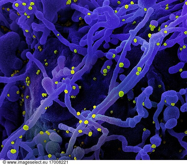 Koloriertes Rasterelektronenmikroskopbild einer Zelle (lila)  die mit SARS-CoV-2-Viruspartikeln (gelb) infiziert ist und aus einer Patientenprobe isoliert wurde. Das Bild wurde in der NIAID Integrated Research Facility (IRF) in Fort Detrick  Maryland  aufgenommen. Bildnachweis: NIAID.