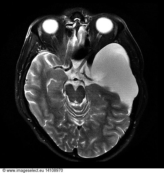 Large Arachnoid Cyst Large Arachnoid Cyst, MRI,abnormal arachnoid ...