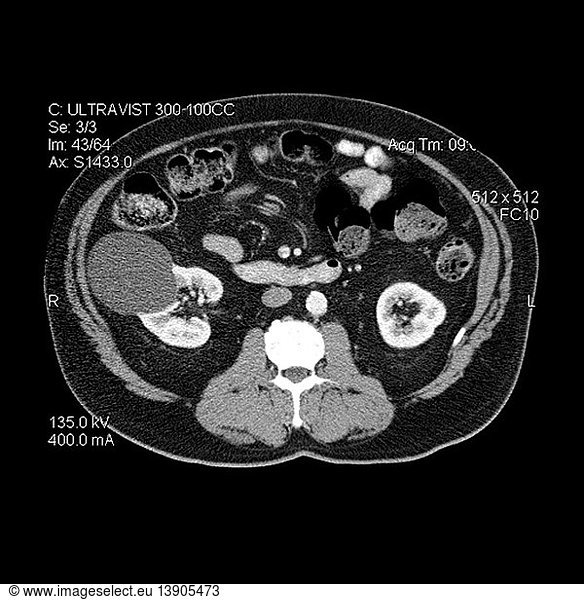 large-benign-kidney-cyst-large-benign-kidney-cyst-abdominal-cyst-benign