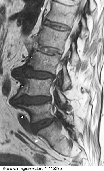 Large Bone Spurs Lumbar Spine Large Bone Spurs Lumbar Spine, MRI