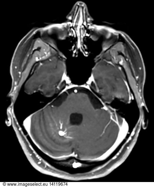 Large Developmental Venous Anomaly Large Developmental Venous Anomaly ...