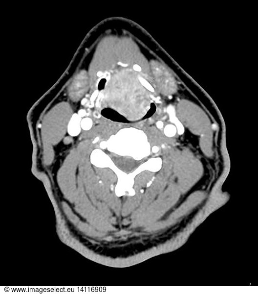 Large Squamous Cell Cancer of Larynx Large Squamous Cell Cancer of ...