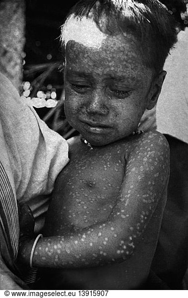 Last Known Case of Naturally-Occurring Smallpox  1975  1 of 2