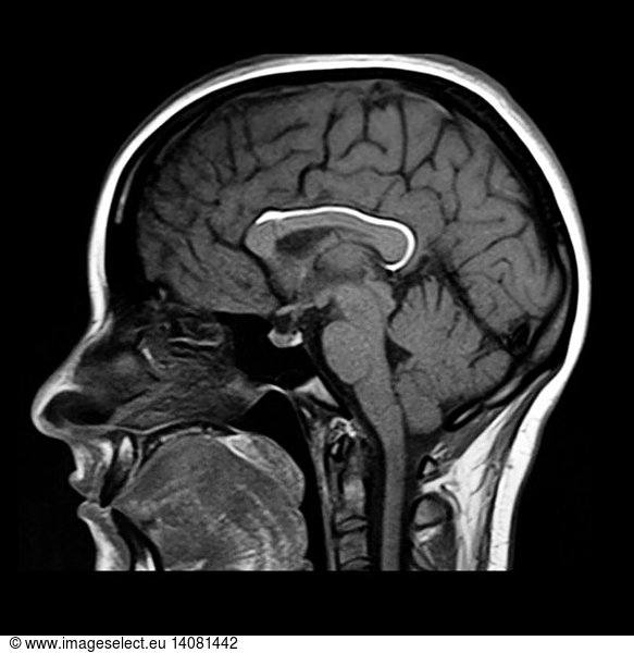 Lipoma of Corpus Callosum Lipoma of Corpus Callosum,abnormal mr head ...