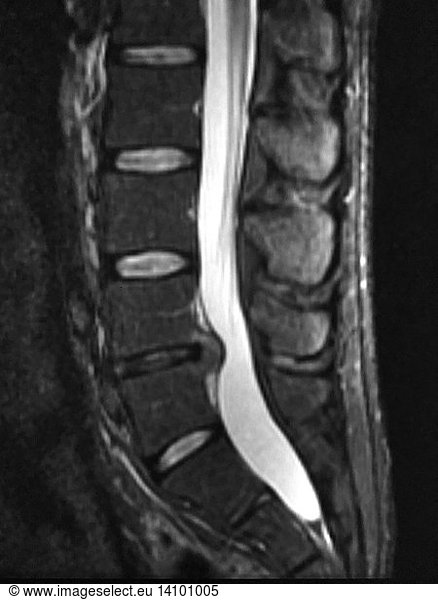 Lumbar Disc Herniation Lumbar Disc Herniation, MRI,abnormal Mri Lumbar ...