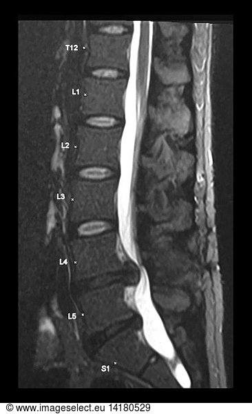 Lumbar Disc Herniations On Mri Lumbar Disc Herniations On Mri Disc Herniation Herniated Nucelus