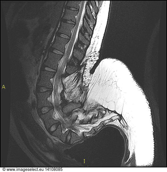 Lumbar Spine Mri In Achondroplastic Dwarf Lumbar Spine Mri In