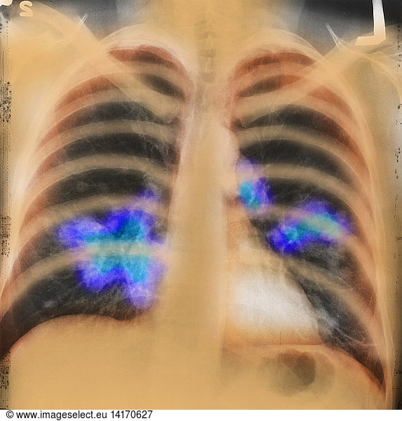 Imaging Demonstrates A Metastatic Lung Cancer A Chest X Ray Shows A My Xxx Hot Girl