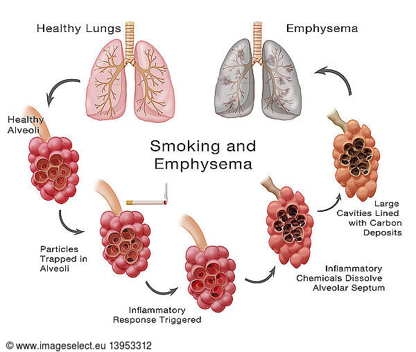 Lung Damage Leading to Emphysema Lung Damage Leading to Emphysema ...