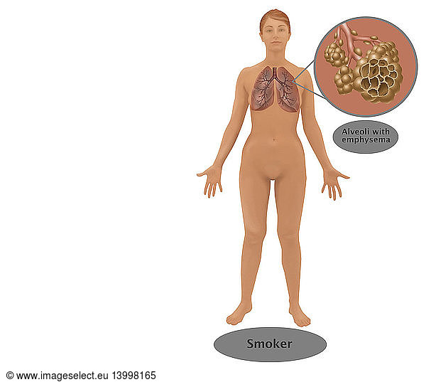 Lungs & Alveoli of a Smoker
