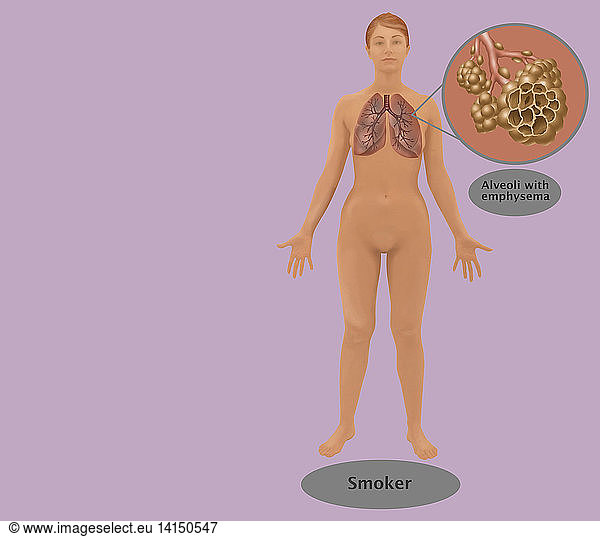 Lungs & Alveoli of a Smoker