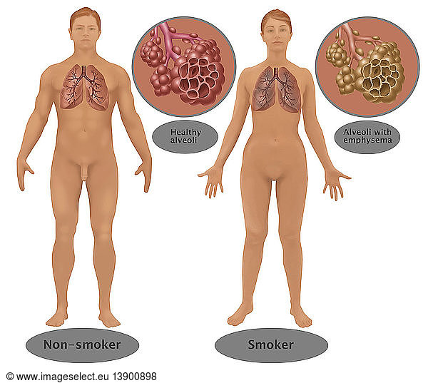 Lungs & Alveoli of Smoker vs. Non-Smoker
