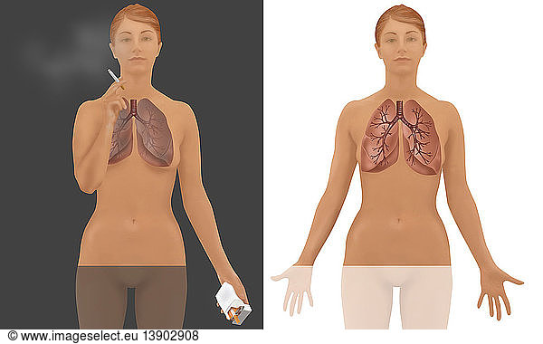 Lungs of Smoker vs. Non-Smoker