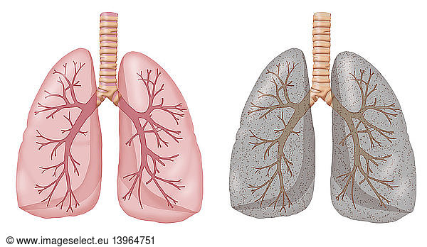 Lungs of Smoker vs. Non-Smoker