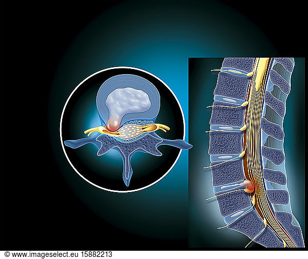 Medical Illustration Showing A Lumbar Disc Herniation At The Level Of 