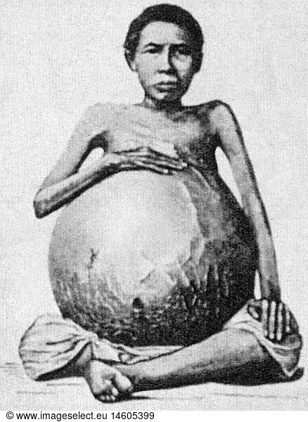 medicine sick person woman with belly swollen by an ovarian cyst Thailand full length sitting sit upper part of the body upper body strip the waist stripped the waist belly bellies tummy ill ovarian cyst ovarian cysts illness illnesses disease diseases medicine medicines sick person sick people woman women historic historical woman women female people