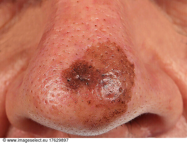 Melanoma of Dubreuilh of the tip of the nose in a 72 year old man.