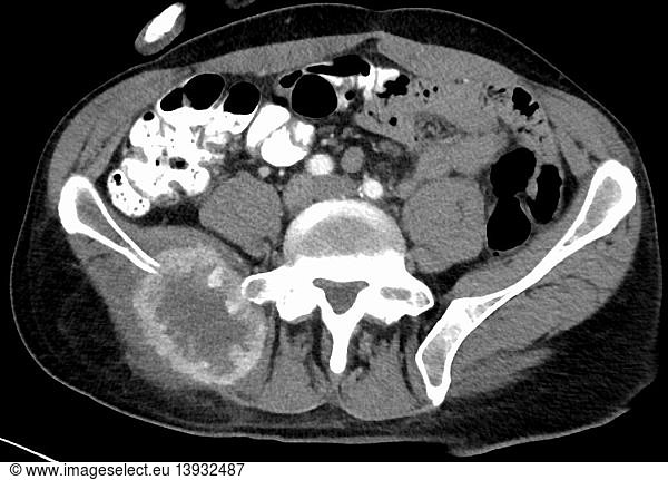 Metastatic renal carcinoma Metastatic renal carcinoma, pelvis, CT scan ...