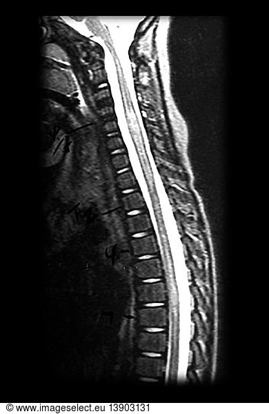 MRI of ADEM MRI of ADEM,abnormal MR spinal cord,acute disseminated ...