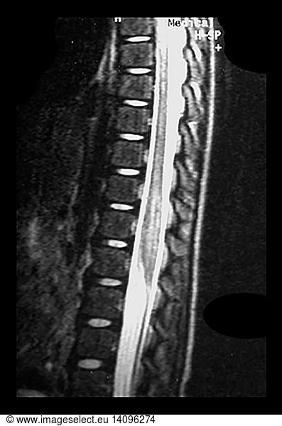 MRI of ADEM MRI of ADEM,abnormal MR spinal cord,acute disseminated ...