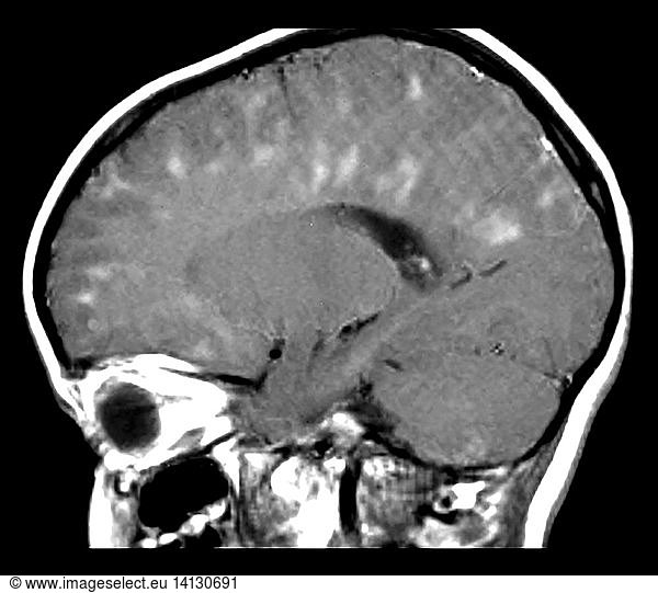 MRI of ADEM MRI of ADEM,abnormal mr brain,acute disseminated ...