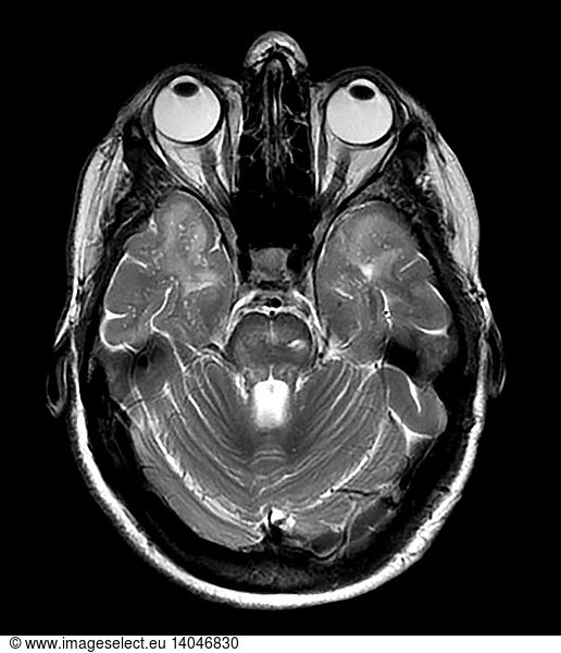 MRI of CADASIL MRI of CADASIL,abnormal mri brain,brain lesion,cerebral ...