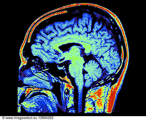 mri-of-normal-brain-mri-of-normal-brain-38-years-old-38-years-old-brain