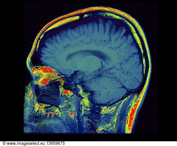 mri-of-normal-brain-mri-of-normal-brain-38-years-old-38-years-old-brain